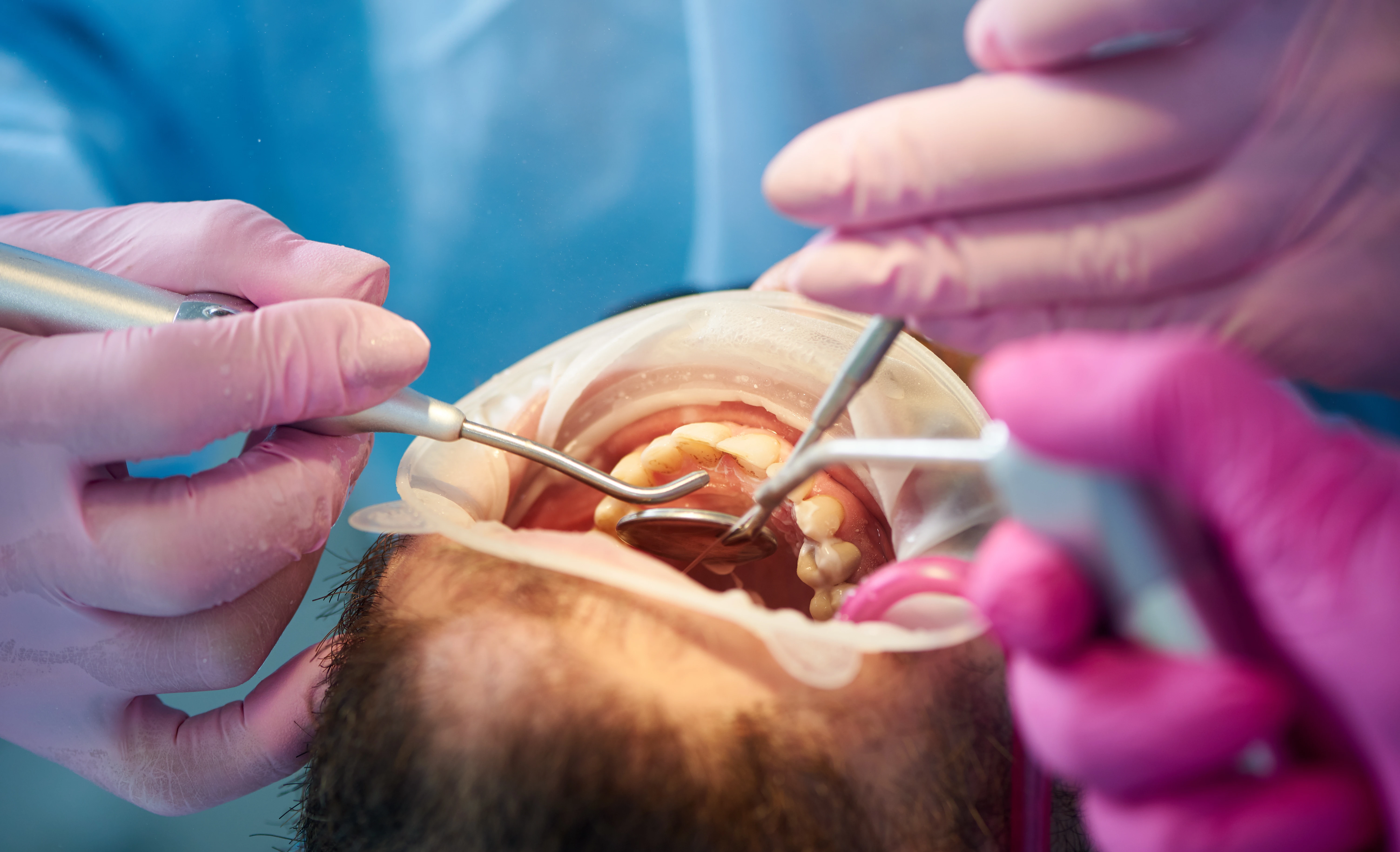Root Canal Treatment